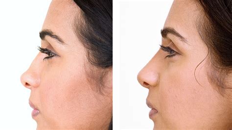 Harley street Non-Surgical Nose Job | Nose fillers - Milo Clinic