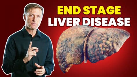 10 Signs of a Dying Liver (End Stage Liver Disease)