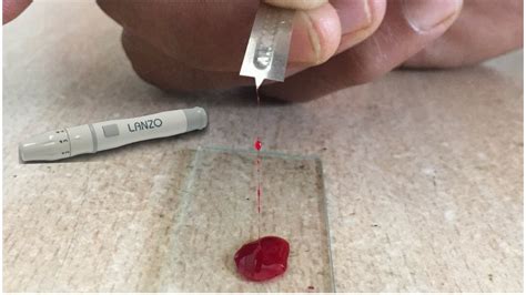 Blood Clotting Time Determination by Slide Method | Blood Clotting Time | Find Blood Clotting ...