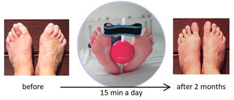 Treatment of Hallux valgus and Haluks – CompleVita – Treatment of foot disorders by qualified ...