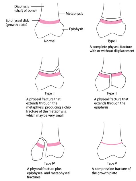 Pediatric Physeal (Growth Plate) Fractures - Injuries; Poisoning - MSD ...