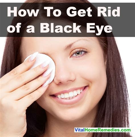 How to Get Rid of a Black Eye | Vital Home Remedies | Black eye remedies, Bruises remedy, How to ...