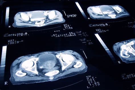 LDR-BT Boost Plus EBRT, ADT Improves Survival in High-Risk Prostate Cancer - Oncology Nurse Advisor