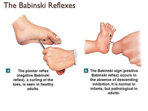 The Babinski reflex is normal in infants but abnormal in adults. Normal adults will exhibit the ...