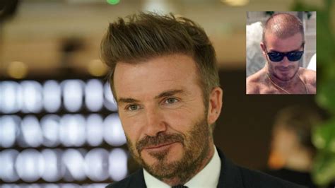 David Beckham Hair Transplant Rumors Explored - CLINIQUEPLUS