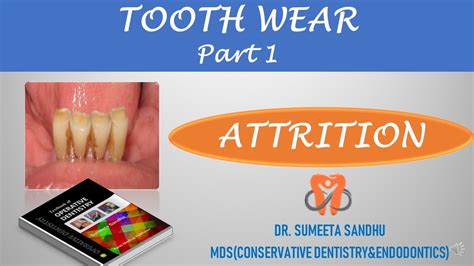 Attrition of teeth - YouTube