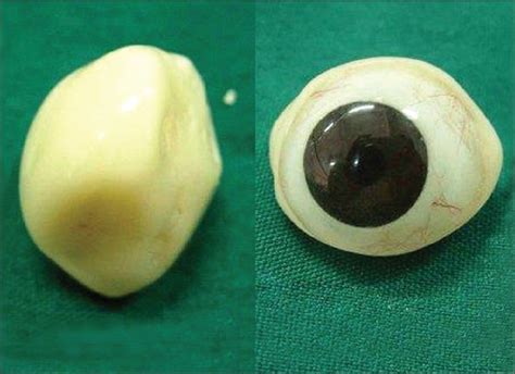 Figure 5: Completed ocular prosthesis | Ocular prosthesis, Health, Ocular