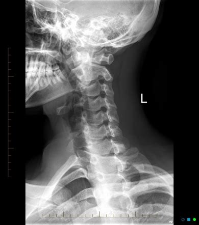 Cervical spine series | Radiology Reference Article | Radiopaedia.org