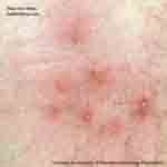 Mite Bites: Symptoms, Treatment and Prevention