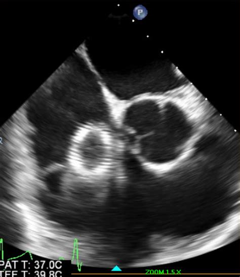 Iliac Vein Stent Migration to the Right Ventricle - American College of Cardiology