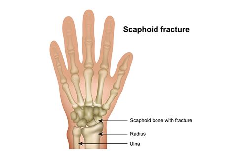 Scaphoid Fracture | Direct Orthopedic Care