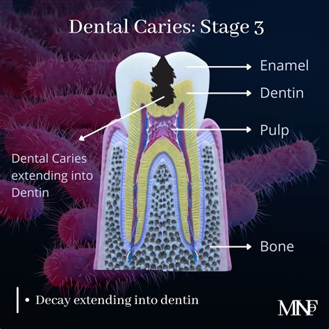 Stages of Dental Caries - Smile Specialists