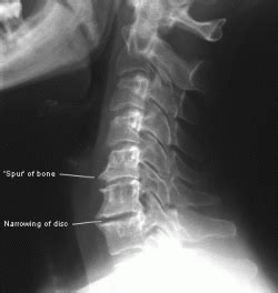 Arthritis and degeneration in the spine - Ridiculously Well