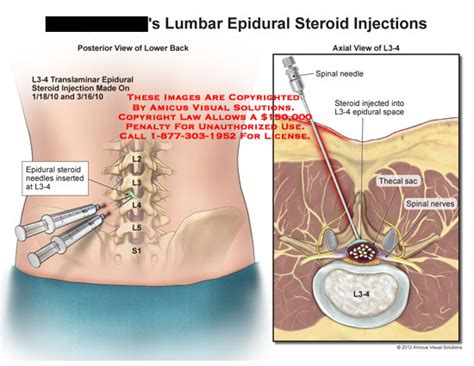 AMICUS Illustration of amicus,medical,lumbar,spine,epidural,steroid,injections,lower,back ...