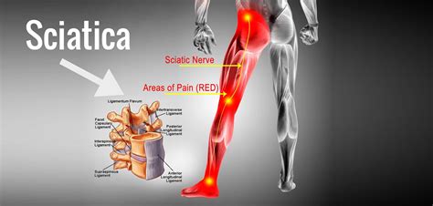 Sciatica Pain Relief Gaithersburg MD | Active Family Chiropractic