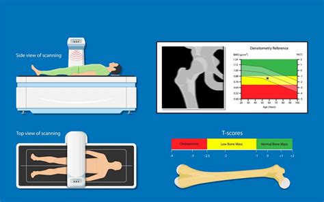 An Abnormal Bone Density Scan