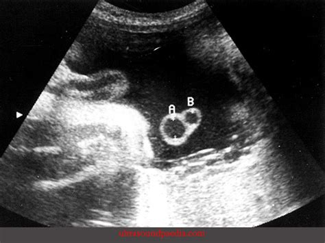 Single umbilical artery – ULTRASOUNDPAEDIA