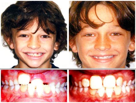 Before and After - dk orthodontics | Caldwell Parsippany NJ