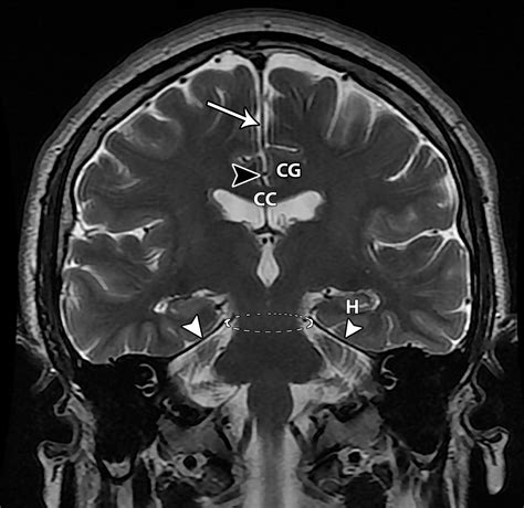 Types of Cerebral Herniation and Their Imaging Features | RadioGraphics