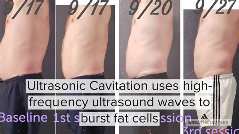 Ultrasonic Cavitation - YouTube