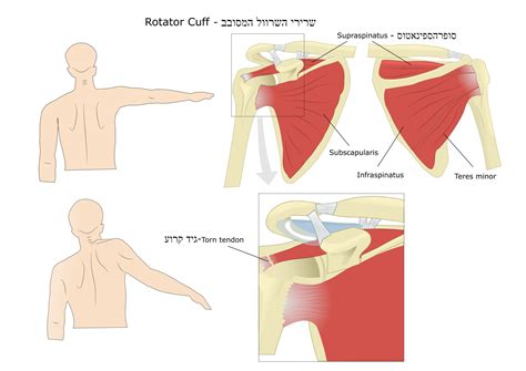 קרע בגיד הכתף - סופראספינטוס