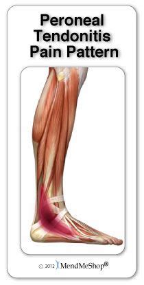 Tendonitis treatment, Sprained ankle remedies, Peroneal tendonitis