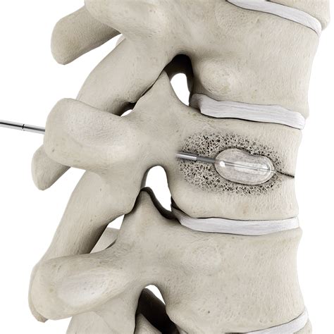 Balloon kyphoplasty | Interventional Spine