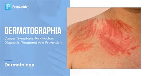 Dermatographia: Causes, Symptoms, Risk Factors, Diagnosis