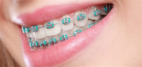 How To Relieve The Pain Of Braces - Contestgold8