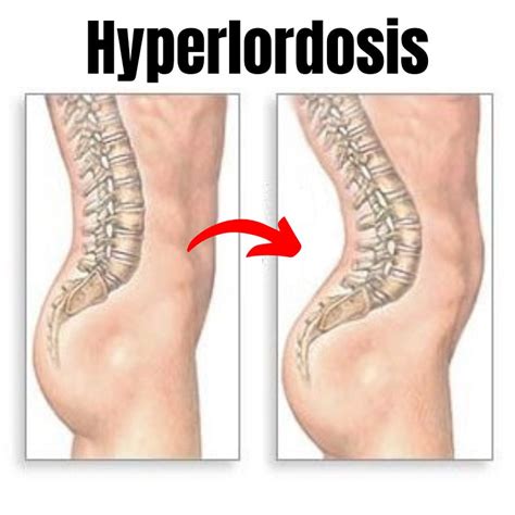 Understanding Hyperlordosis: Symptoms, Causes, and Treatment Options – OrthoRelieve