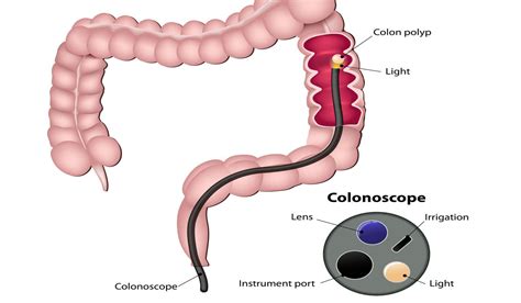 Venkateshwar Platinum Health Checkup Package With Colonoscopy