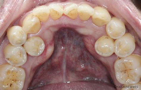 Extra Tooth: Mesiodens and Other Supernumerary Teeth | Oral Answers