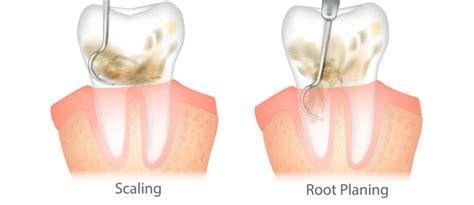 Scaling and Root Planing: A Guide to Dental Deep Cleaning