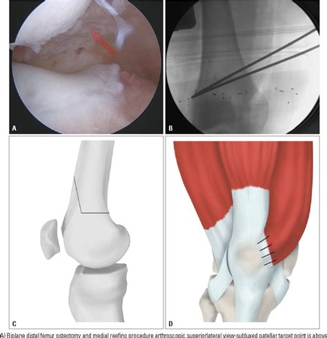 distal femoral osteotomy | Semantic Scholar