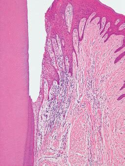 Gingivitis Histology