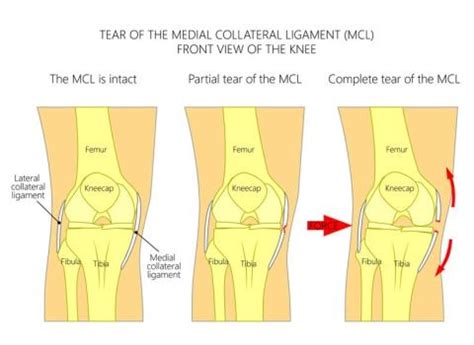 MCL Injury | Signs, Symptoms, Treatment & Prevention