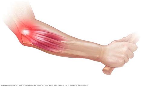 Lateral Elbow Tendinopathy (Tennis Elbow) - Physiosteps