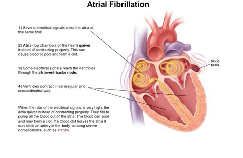 What is Atrial Fibrillation (Afib)?