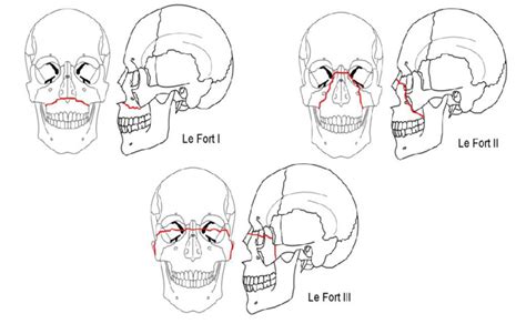 Le Fort 1 Maxillary Fracture