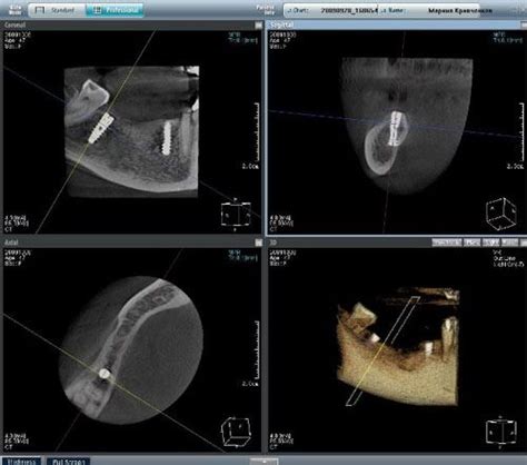 Methods of treatment in case of Nervous Mandibular is Injury caused by Dental Implant - Sigma ...