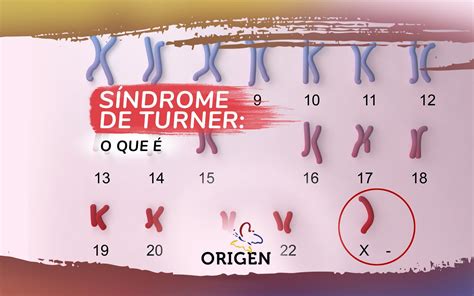 Sindrome De Turner Cromosoma