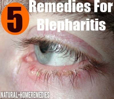 5 Home Remedies For Blepharitis - Natural Treatment And Cure For ...