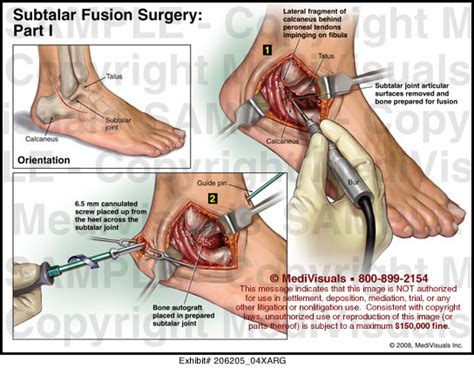 Medivisuals Subtalar Fusion Surgery - Part I Medical Illustration