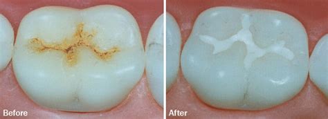 Pit and fissure sealants - Sri Vinayaga Dental Clinic