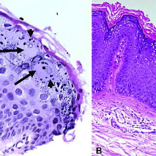 Histopathologic findings in epidermodysplasia verruciformis and... | Download Scientific Diagram