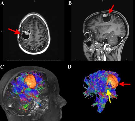 Cureus | Automated Whole Brain Tractography Affects Preoperative ...