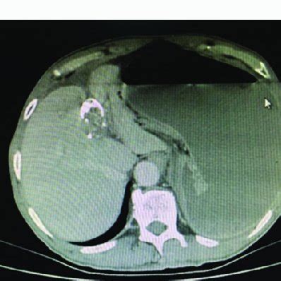 Gastric dilatation and volvulus observed during operation. | Download Scientific Diagram