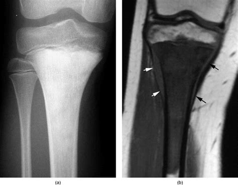 Imaging of periosteal reactions associated with focal lesions of bone ...