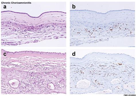 File:Chronic chorioamnionitis histology.jpg - Embryology