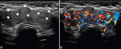 Multinodular goiter. Transverse gray-scale ultrasound ( | Open-i